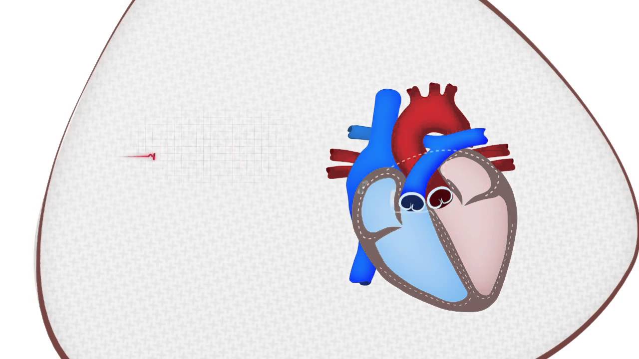 Was ist der plötzliche Herztod?